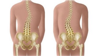 A nem-strukturális scoliosis