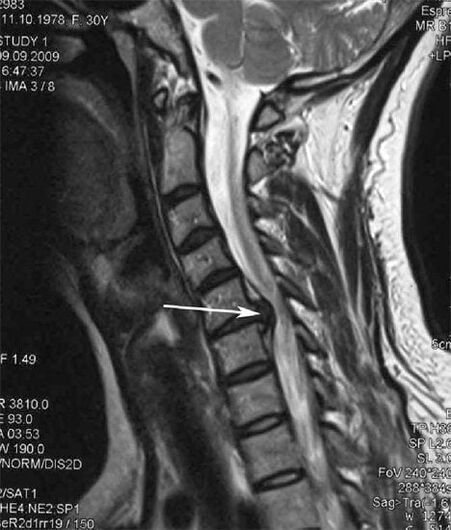 A gerincvelő sérülése kiváltja a nyaki fájdalmat