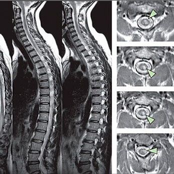 mellkasi osteochondrosis diagnózisa