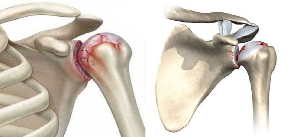 a vállízület pusztulása arthrosissal