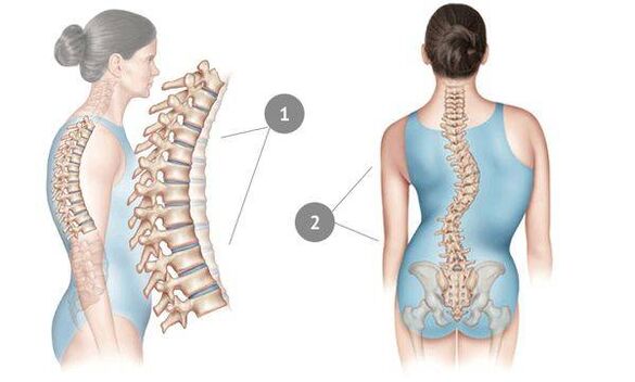 a gerinc görbülete, mint a mellkasi osteochondrosis oka