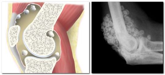 chondromatosis fájdalommal a csípőízületben